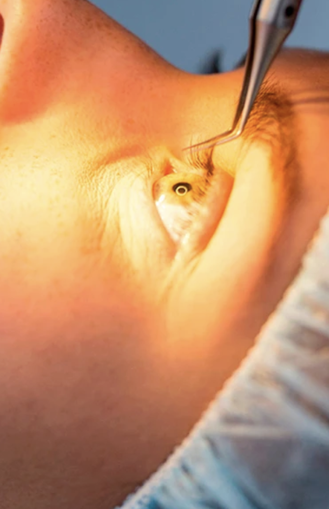 Cirurgia refrativa — exame e procedimento