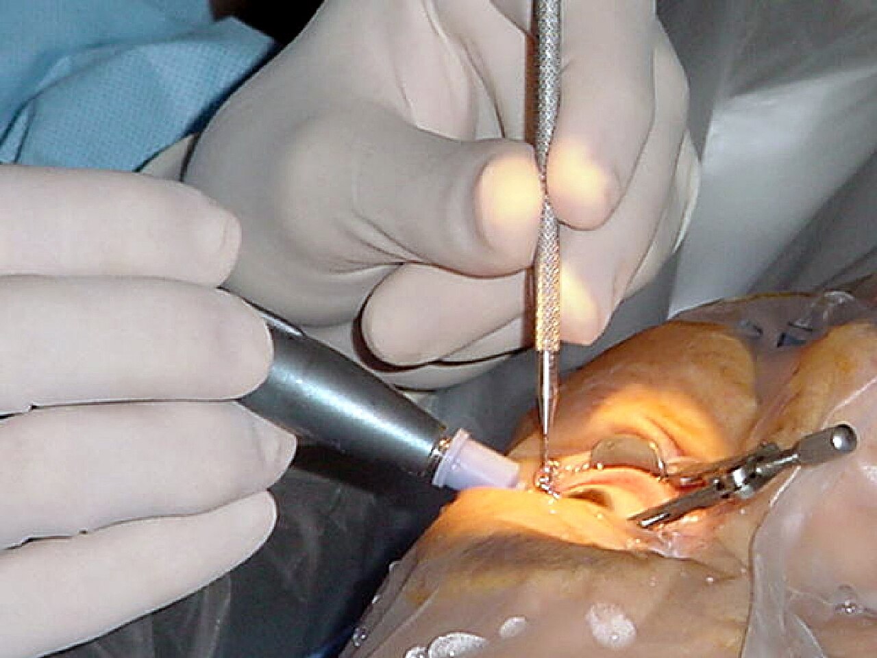 Cirurgia de catarata em centro cirúrgico