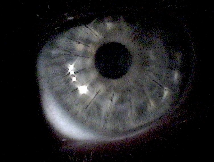 Córnea transplantada em acompanhamento pós-operatório