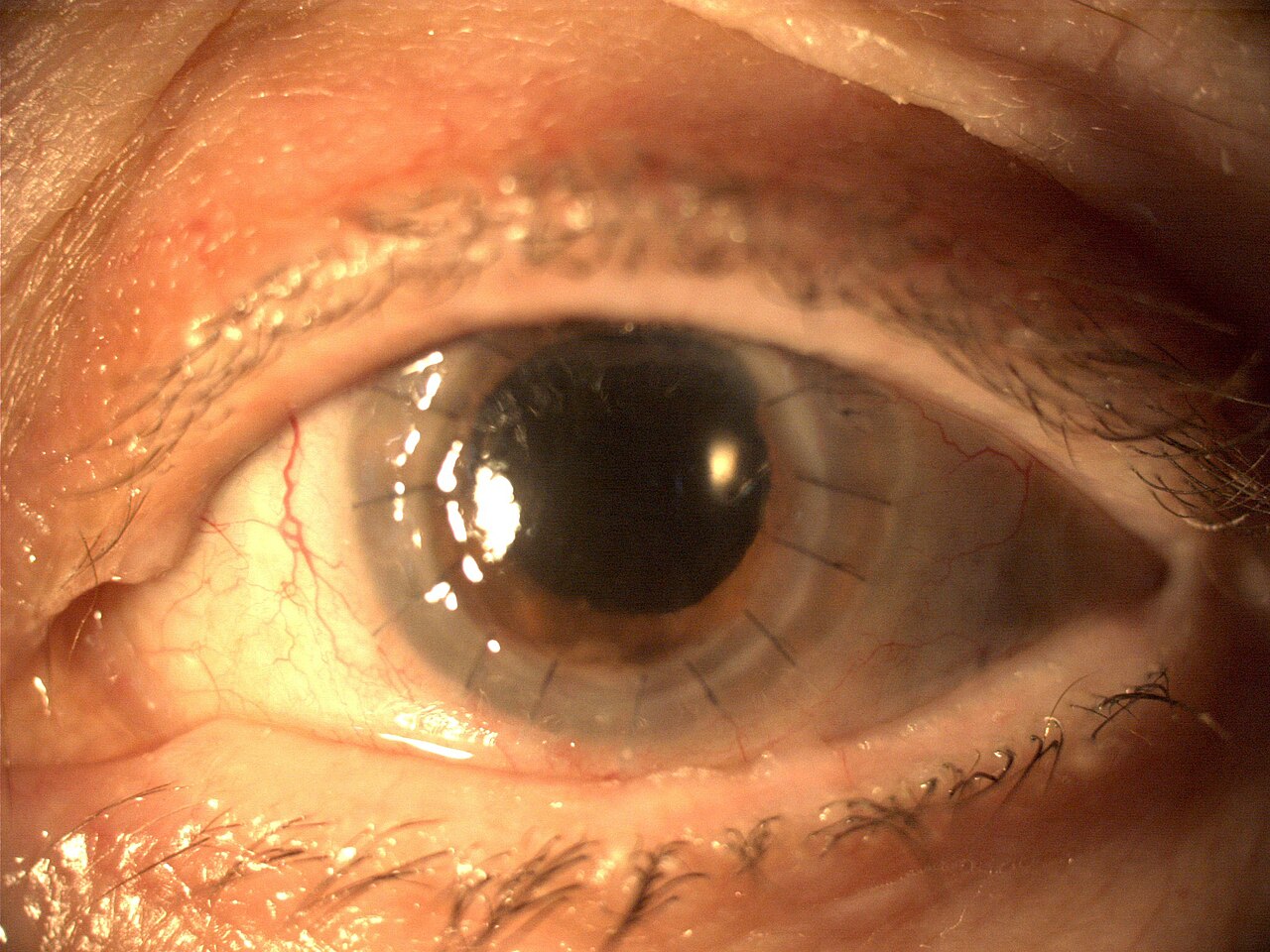 Córnea após ceratoplastia, com suturas visíveis